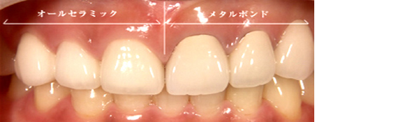 オールセラミックとメタルボンドの違い