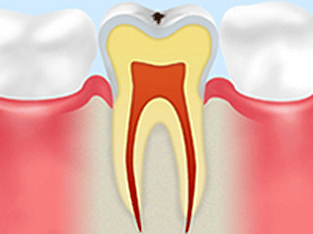 ごく初期のむし歯