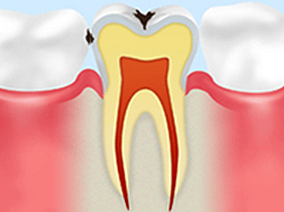 エナメル質のむし歯