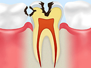 象牙質のむし歯