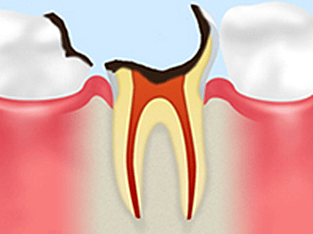 神経に達したむし歯