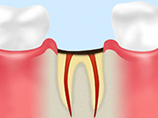 歯根に達したむし歯