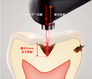 ダイアグノデント